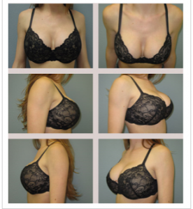 Breast Enhancement Pills result