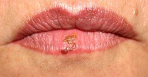 herpes 
