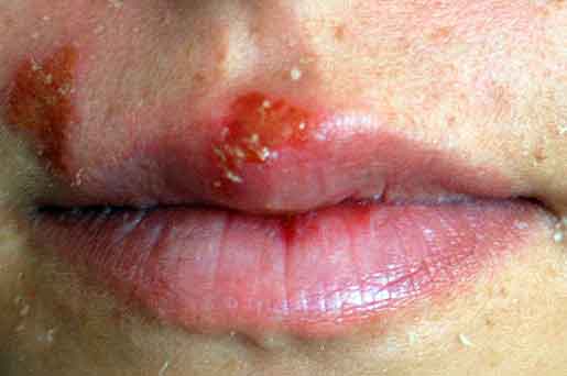 Herpes 12