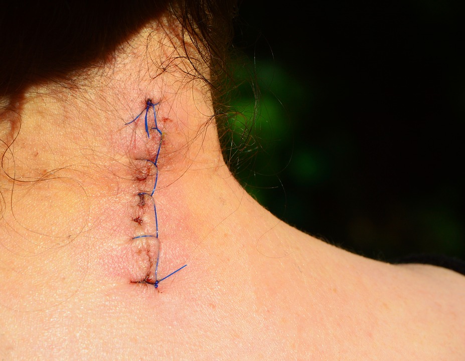 stitches