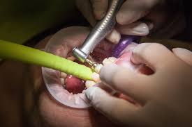 tooth filling